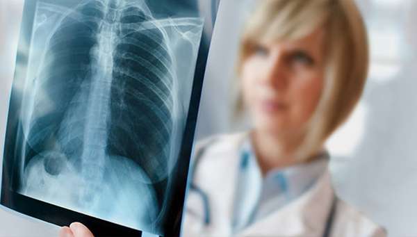 Doctor examining a lung scan