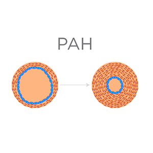 Pulmonary Arterial Hypertension Diagram