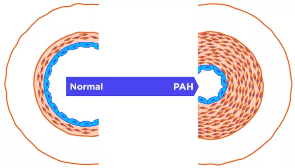 Breath analysis for diagnosis of Pulmonary Arterial Hypertension