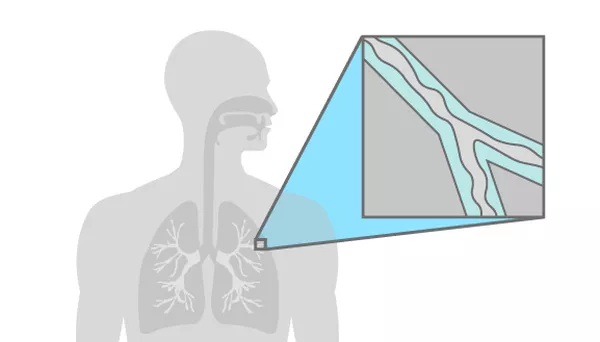 Breath analysis for detecting cystic fibrosis and Pseudomonas exacerbations