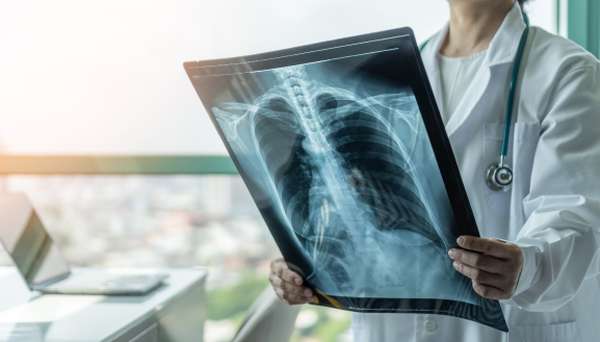 COPD lungs X-ray 