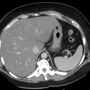 Liver scan photo