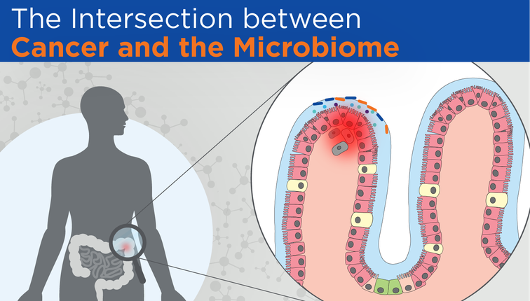 A Blog post on The Intersection between Cancer and the Microbiome