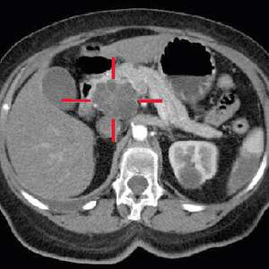 STA scan of Pancreatic Cancer