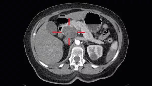 FAIMS could be a non-invasive solution for pancreatic cancer detection