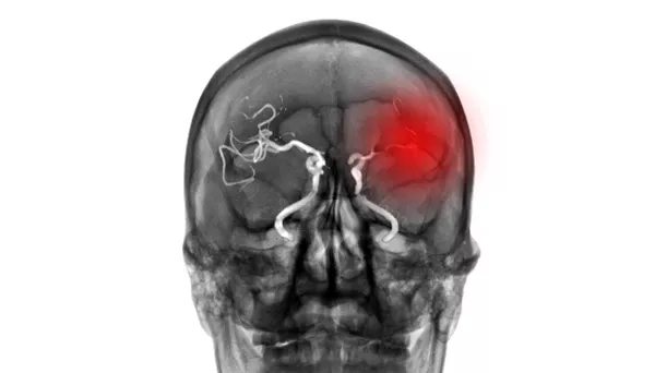 Assessing inflammation in stroke patients