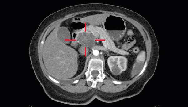 STA scan of Pancreatic Cancer