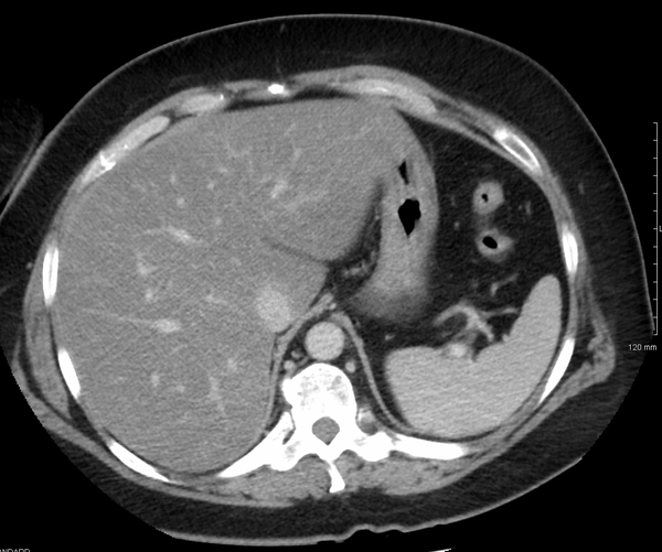 Liver scan photo