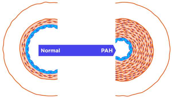 Pulmonary Arterial Hypertension Diagram