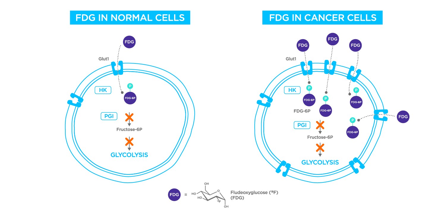FDG in cancer cells