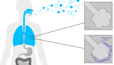 The Early Detection of Idiopathic Pulmonary Fibrosis (IPF) Using Breath Analysis