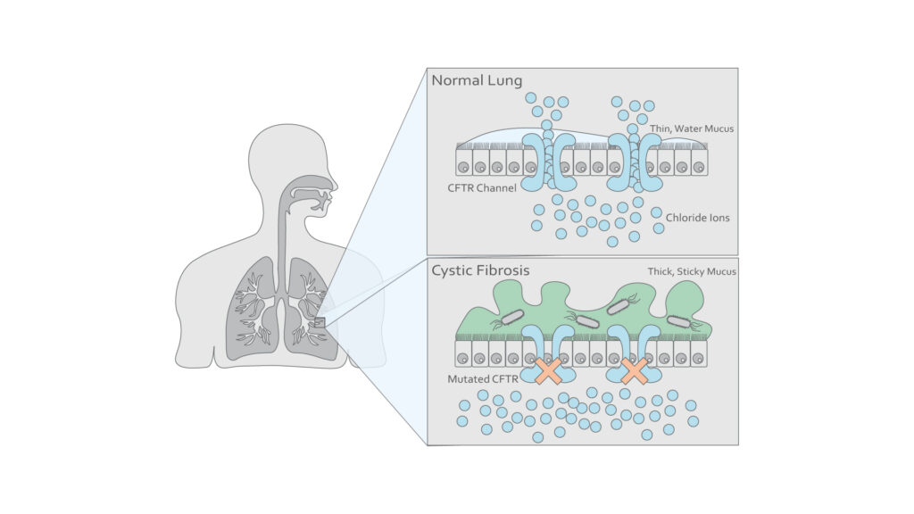 Cystic Fibrosis Figure 1