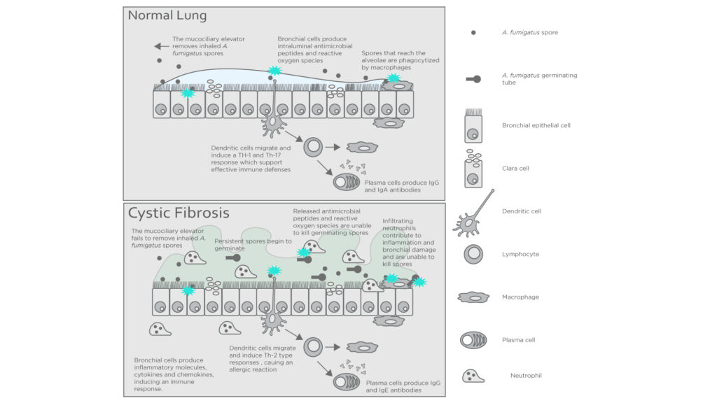 Cystic Fibrosis Figure 2