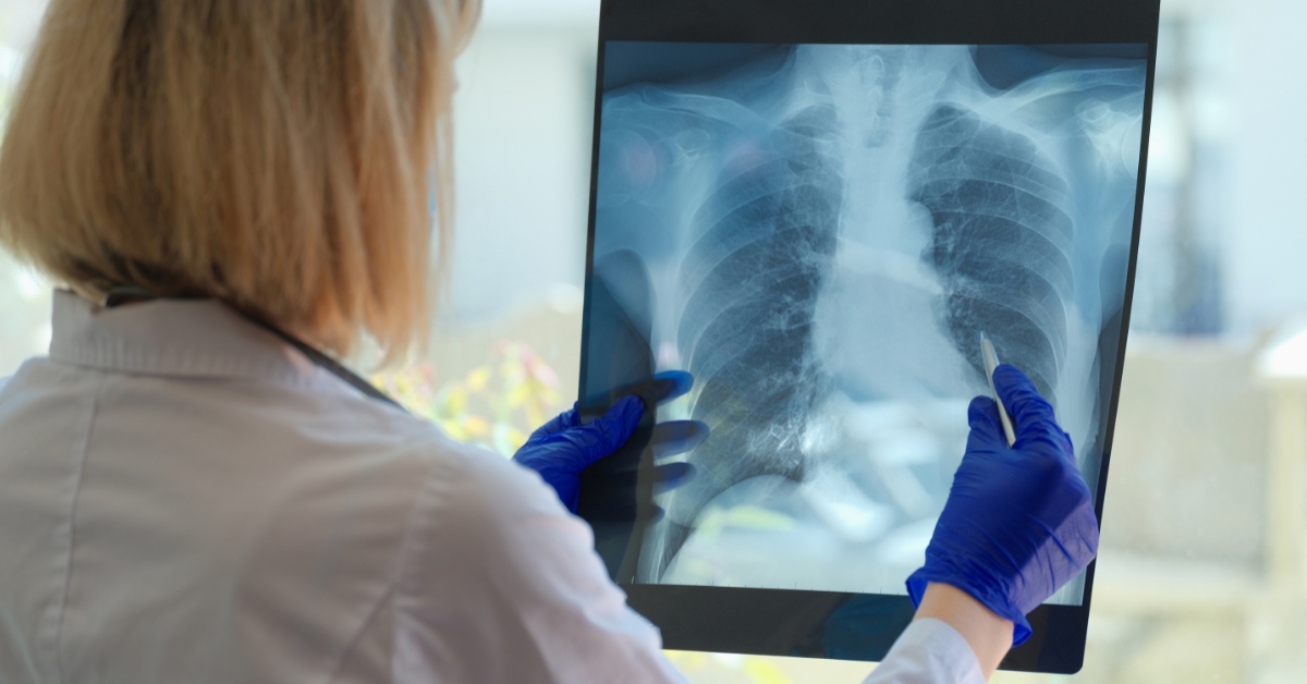 Breath Analysis for Diagnosing Viral Infections in COPD