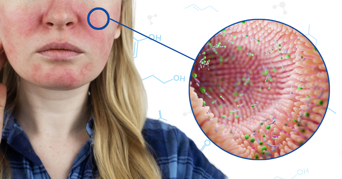 Discover the link between SIBO and Rosacea