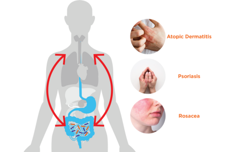How the Gut Microbiome Influences Skin Health: Exploring the Gut-Skin Axis
