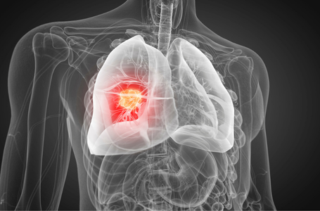 lung cancer